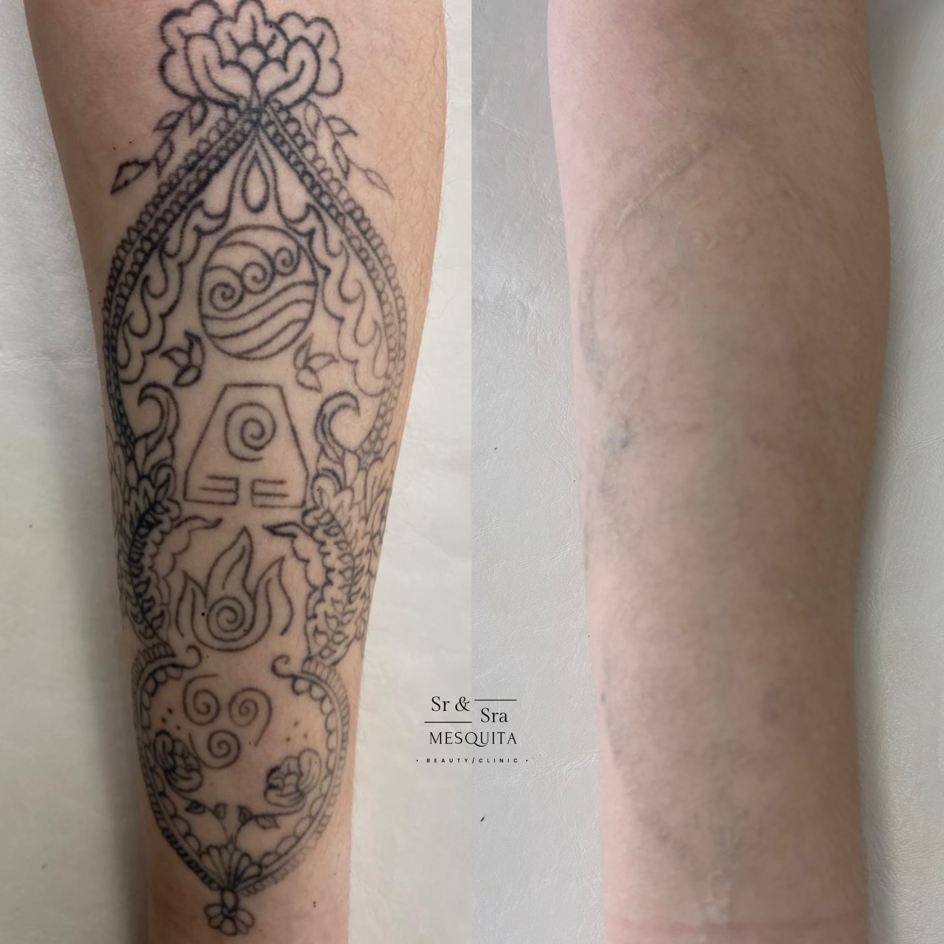 Tatuagem antes e depois da despigmentação