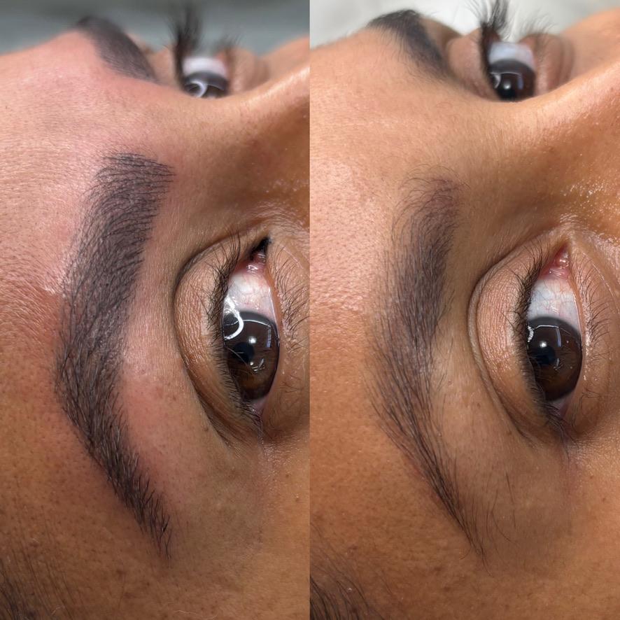 Sobrancelha antes e depois da despigmentação
